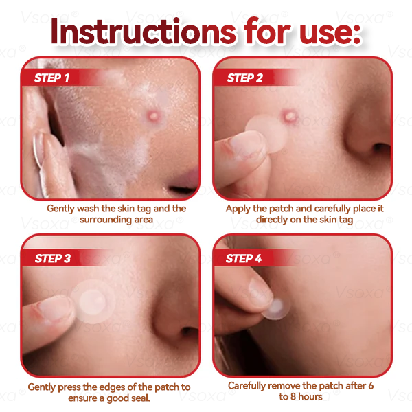 𝑉𝑠𝑜𝑥𝑎® 💧 Microneedling Plantaardige Oplossing voor Huidtags Patches 👩⚕️