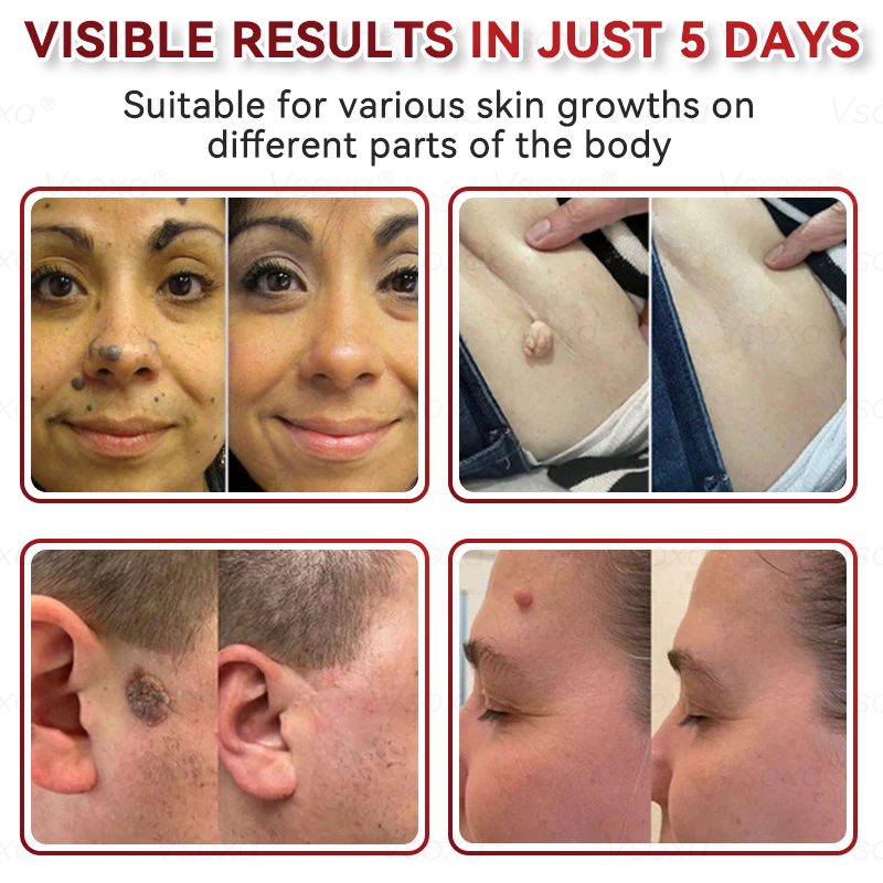 𝑉𝑠𝑜𝑥𝑎® 💧 Microneedling Plantaardige Oplossing voor Huidtags Patches 👩‍⚕️