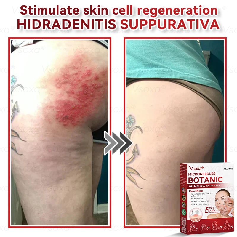 𝑉𝑠𝑜𝑥𝑎® 💧 Microneedling Plantaardige Oplossing voor Huidtags Patches 👩‍⚕️