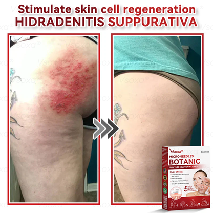 𝑉𝑠𝑜𝑥𝑎® 💧 Microneedling Plantaardige Oplossing voor Huidtags Patches 👩‍⚕️