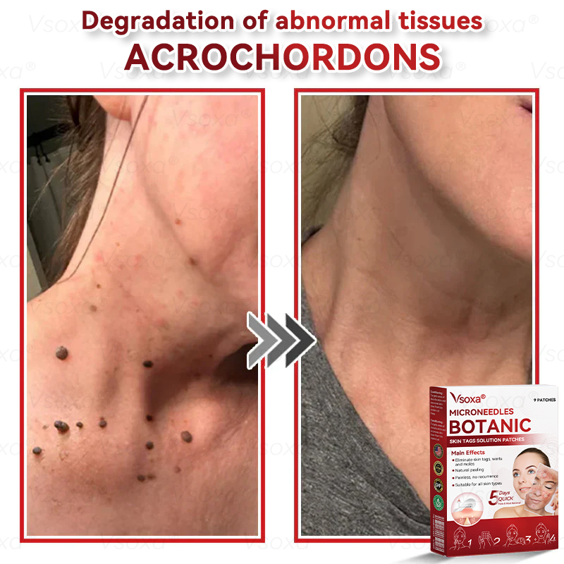 𝑉𝑠𝑜𝑥𝑎® 💧 Microneedling Plantaardige Oplossing voor Huidtags Patches 👩‍⚕️