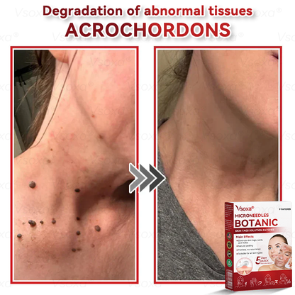 𝑉𝑠𝑜𝑥𝑎® 💧 Microneedling Plantaardige Oplossing voor Huidtags Patches 👩‍⚕️