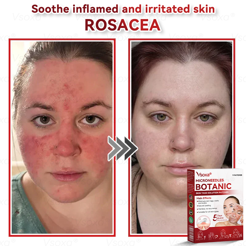 𝑉𝑠𝑜𝑥𝑎® 💧 Microneedling Plantaardige Oplossing voor Huidtags Patches 👩‍⚕️