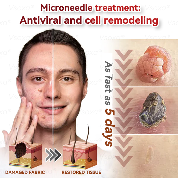 𝑉𝑠𝑜𝑥𝑎® 💧 Microneedling Plantaardige Oplossing voor Huidtags Patches 👩‍⚕️