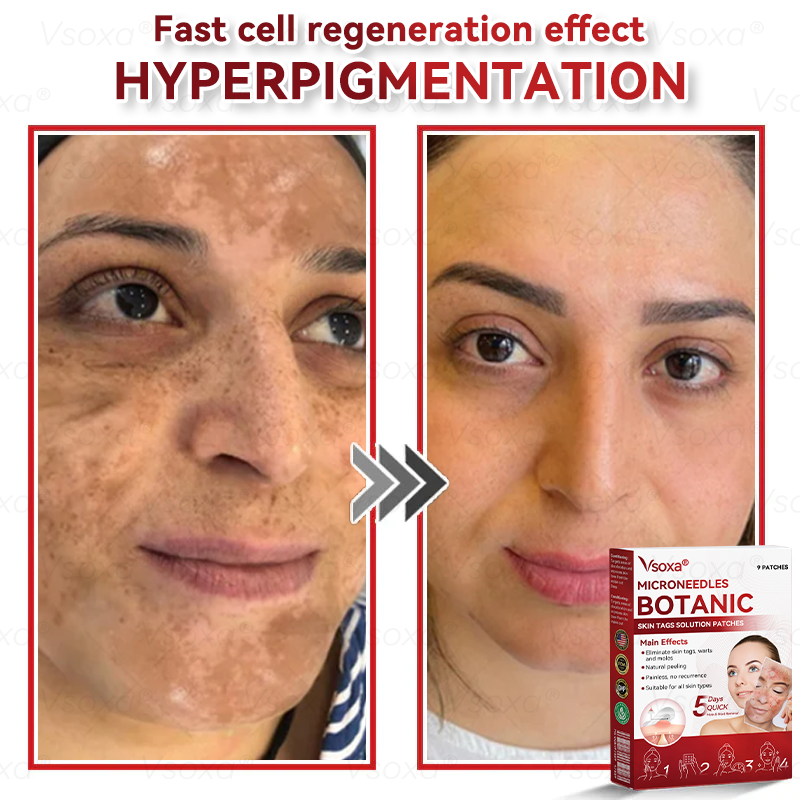 𝑉𝑠𝑜𝑥𝑎® 💧 Microneedling Plantaardige Oplossing voor Huidtags Patches 👩‍⚕️