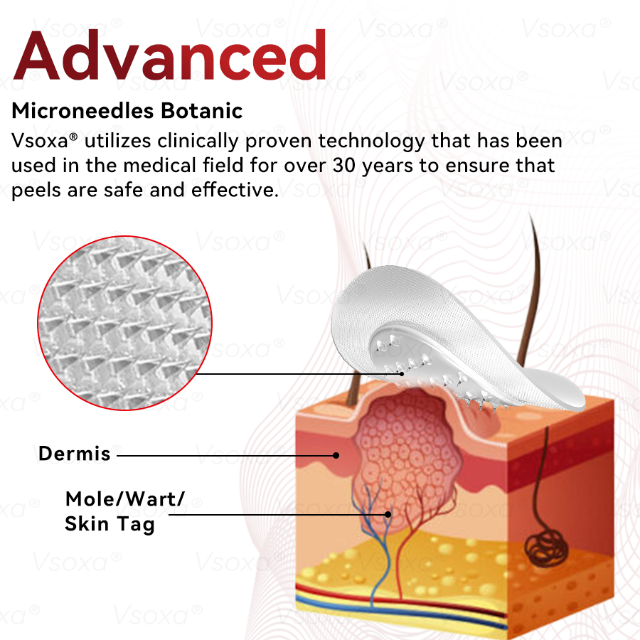 𝑉𝑠𝑜𝑥𝑎® 💧 Microneedling Plantaardige Oplossing voor Huidtags Patches 👩‍⚕️